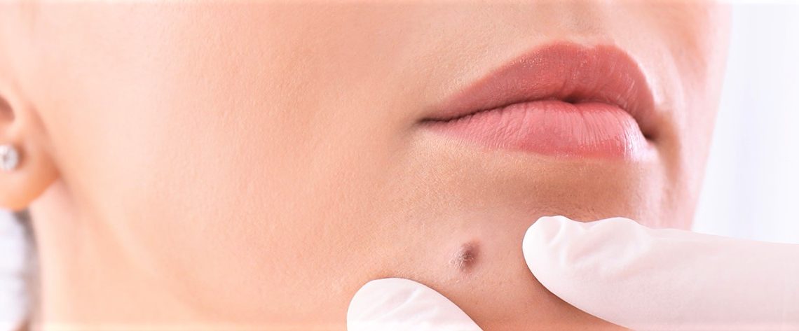 Chirurgie esthétique des tumeurs cutanées : les grains de beauté