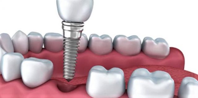 Comment se déroule l’installation d’implants dentaires ?